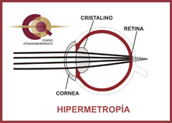 hipermetropia2